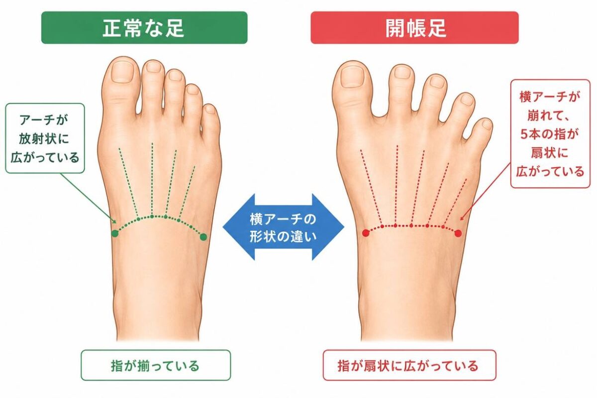 開張足とは横アーチの崩れで起こる状態